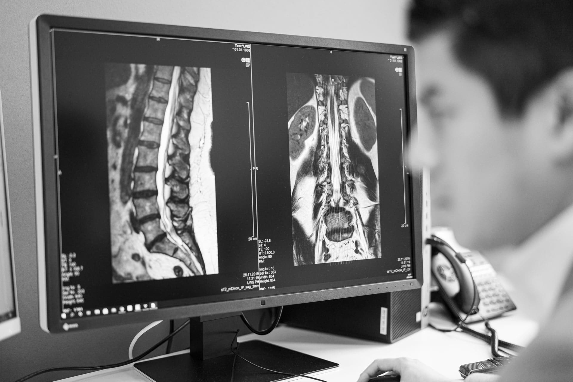 Bandscheibenvorfall Diagnose MRT Befund auf Bildschirm